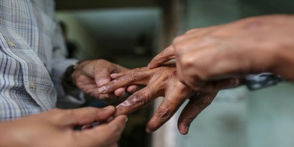 নেপালত নিৰ্মূল ঘোষণাৰ ১৬ বছৰৰ পাছত পুনৰ বিয়পি পৰিছে কুষ্ঠ ৰোগ